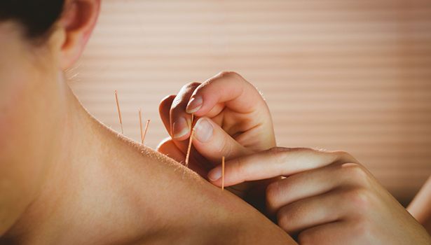 accupuncture
